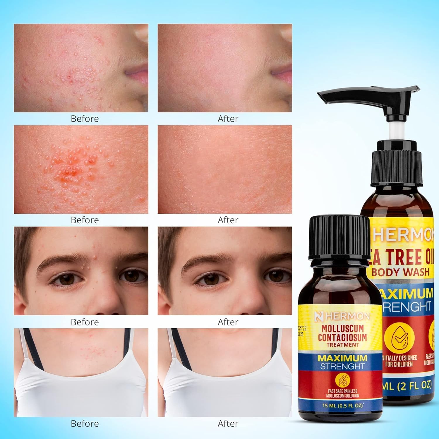 Molluscum Contagiosum Treatment